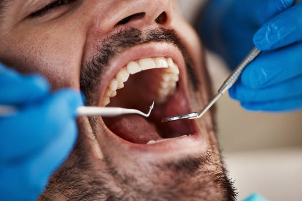 Best Emergency Dentist for Knocked-Out Tooth in Bonita, CA